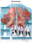 Pneumonia - Anatomical Chart